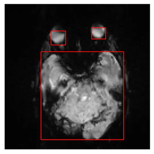 Bounding-box for Brain Cancer MRI